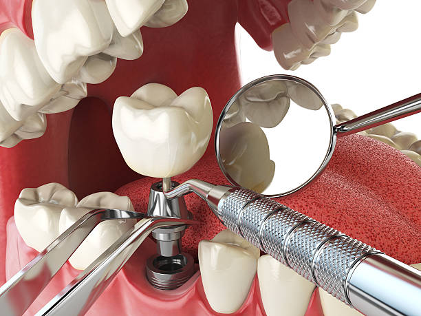 Best Emergency Tooth Extraction in Seward, NE